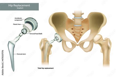 total hip hemiarthroplasty technique